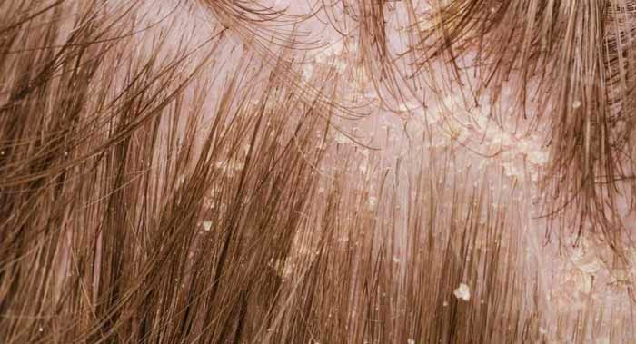 ثلاث وصفات خارقة للتخلص من الفطريات الجلدية وقشرة الشعر
